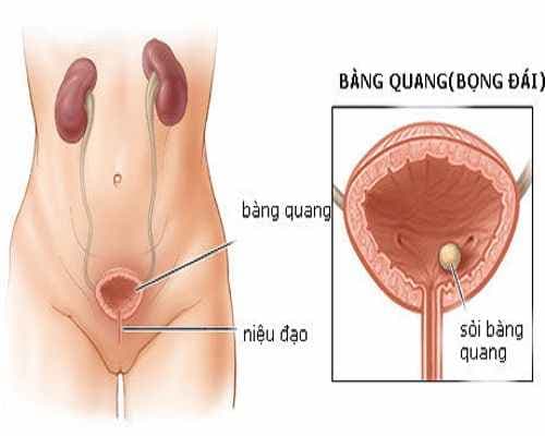 Cách điều trị sỏi bàng quang hiệu quả