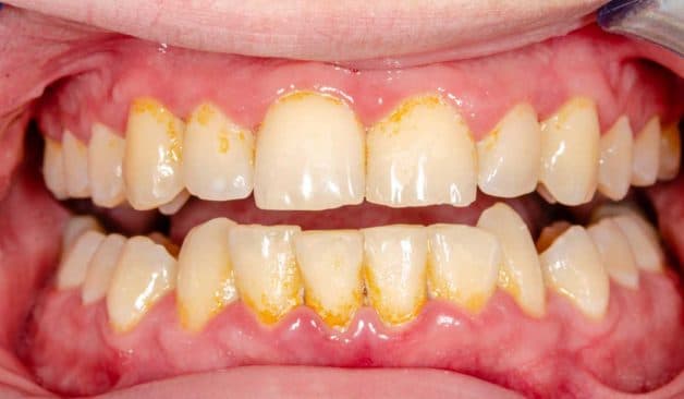 Cao răng là chất lắng cặn cứng đã vôi hoá và không dễ dàng lấy đi bằng các phương pháp vệ sinh răng miệng tại nhà