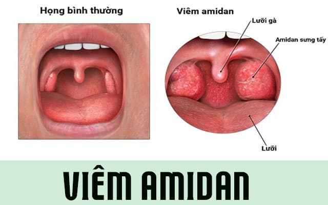 viêm amidan