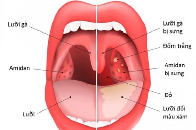 Hình ảnh viêm amidan ở trẻ em