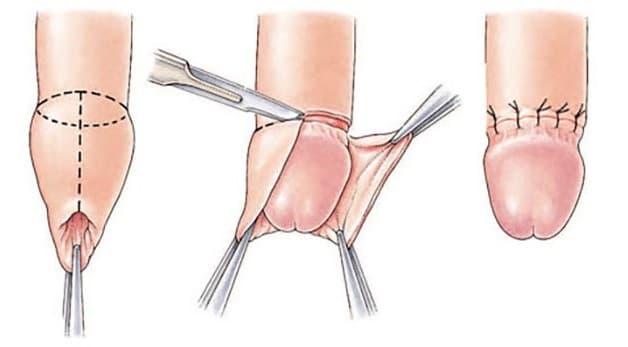 Mô tả quá trình cắt bao quy đầu cho trẻ