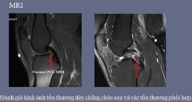 chi phí chụp mri khớp gối là bao nhiêu