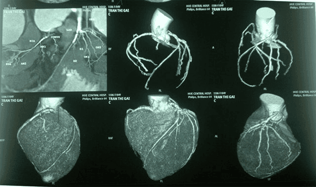 Kỹ thuật chụp CT mạch vành tiêm thuốc cản quang