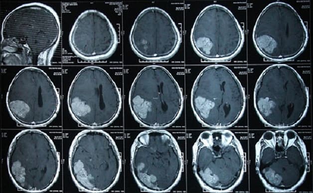 Hình ảnh chụp CT sọ não