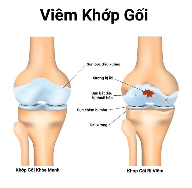 chup mri khớp gối ở đâu