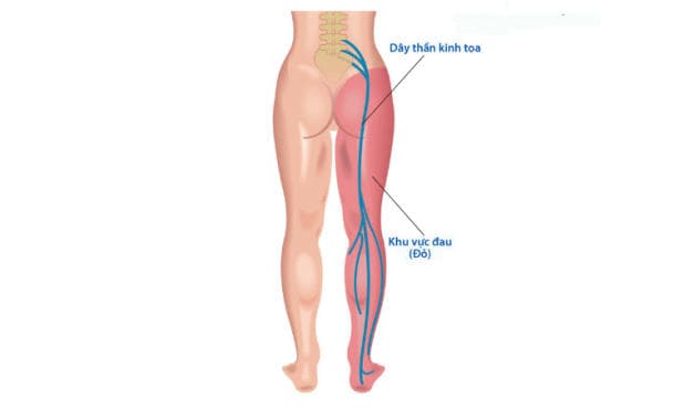 hình ảnh đau thần kinh tọa