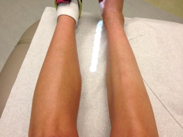 biến chứng từ ít vận động