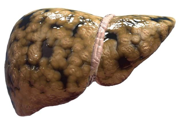 Bệnh gan nhiễm mỡ làm ảnh hưởng đến chức năng gan