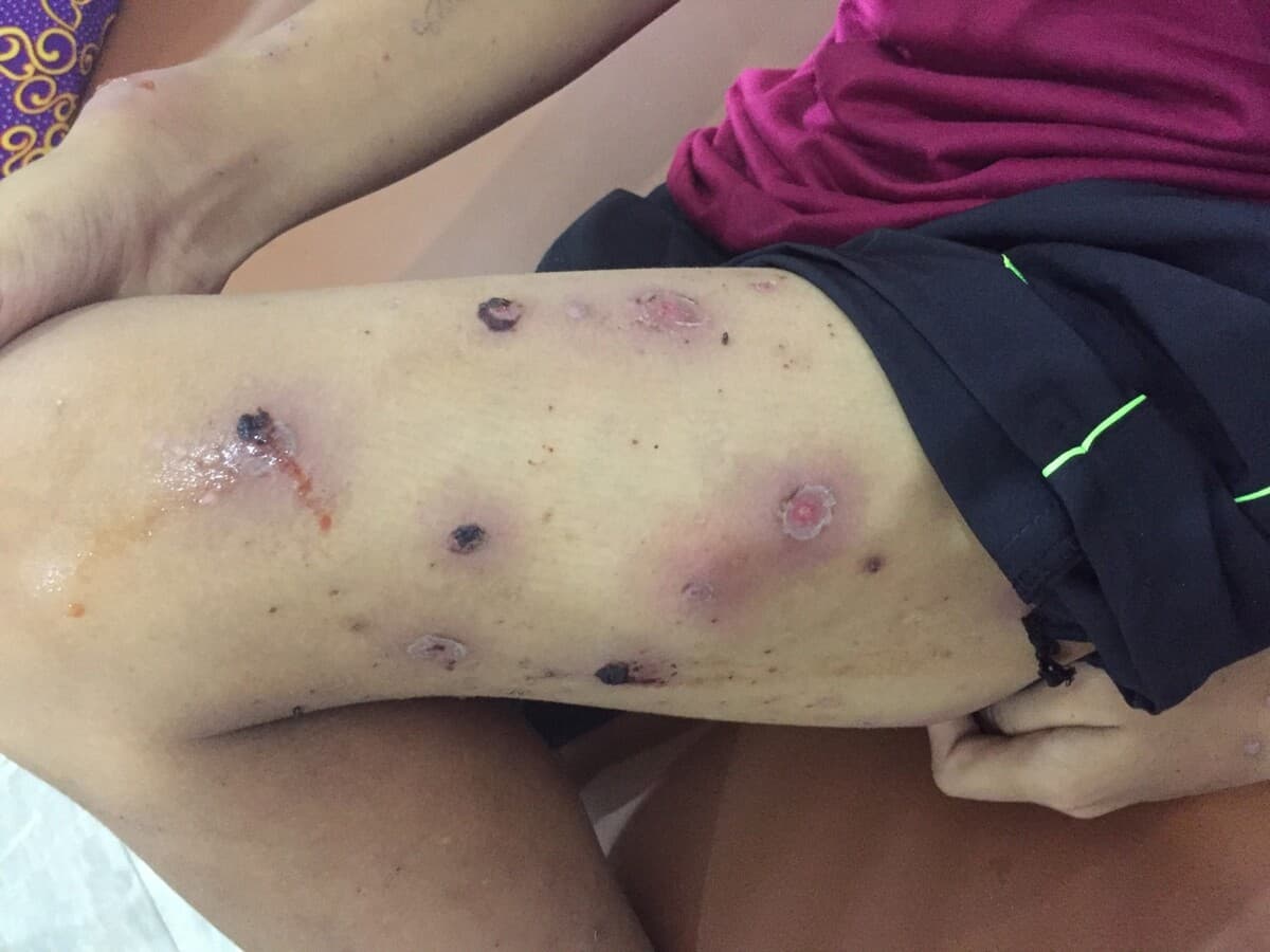 Điều trị thủy đậu ở trẻ em không đúng cách có thể gây ra biến chứng nhiễm trùng huyết