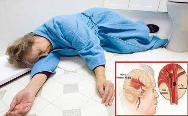 Nguyên nhân gây đột quỵ não thường là do bệnh lý về tim mạch, đái tháo thường,...