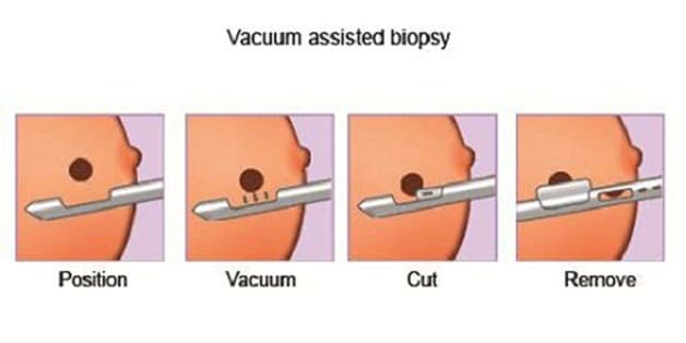 Hút chân không u vú giá bao nhiêu là thắc mắc của nhiều người bệnh