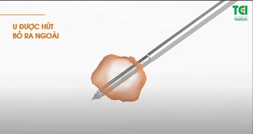 Mục sở thị giải pháp Sinh thiết u vú dưới hướng dẫn của siêu âm và lực hút chân không – Không cần mổ