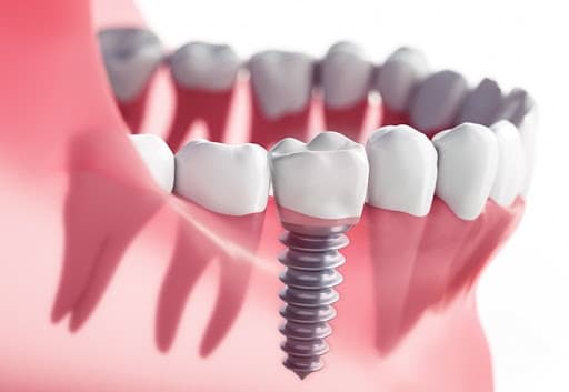 Răng implant được đánh giá cao vì tính thẩm mỹ cũng như sự thuận tiện trong sinh hoạt cho người bệnh