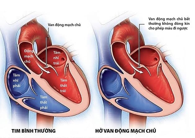 Hở van động mạch chủ là bệnh tim mạch cần được khám và điều trị sớm