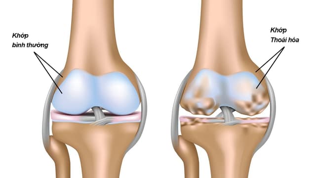 Nguyên nhân của thoái hóa khớp là gì và cách phòng ngừa