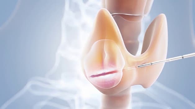 Tìm hiểu nguyên nhân gây u nang tuyến giáp