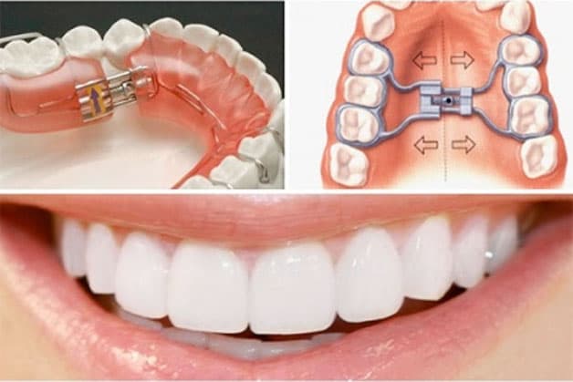 Niềng răng chỉnh nha là phương pháp can thiệp kỹ thuật bằng các thiết bị để nắn chỉnh, sắp xếp các răng sai lệch về đúng vị trí của chúng.