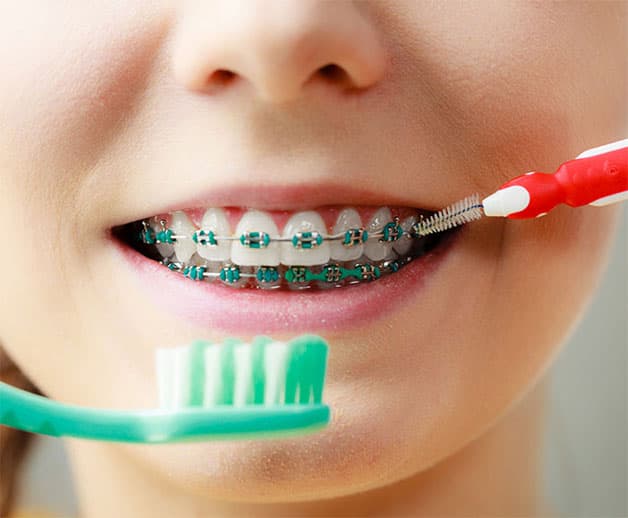 Vệ sinh răng miệng thật kỹ trong quá trình niềng răng.