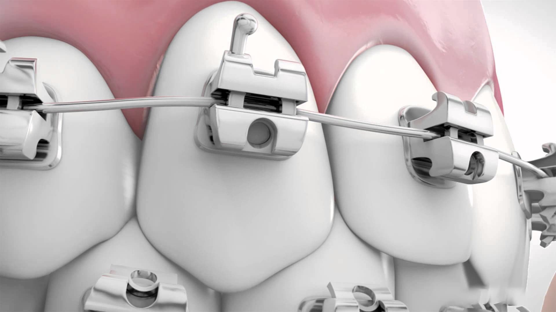 Niềng răng bằng mắc cài tự động có 2 ưu điểm là nắp cài được thiết kế tự động và không cần sử dụng đến dây thun