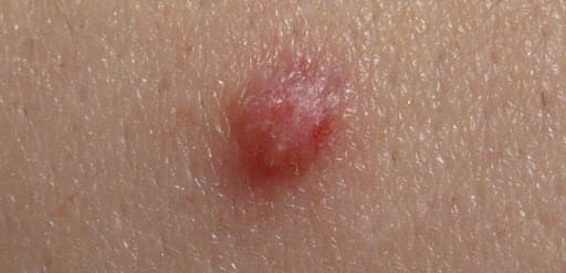 Nổi hạch ở bộ phận sinh dục là tình trạng vùng kín sưng to, gây cảm giác vô cùng khó chịu, đau đớn.