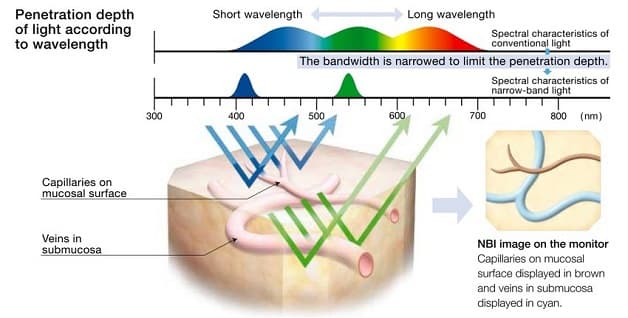 nội soi tiêu hóa NBI ưu điểm 
