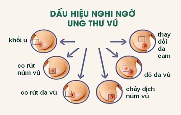 dấu hiệu phát hiện ung thư vú sớm
