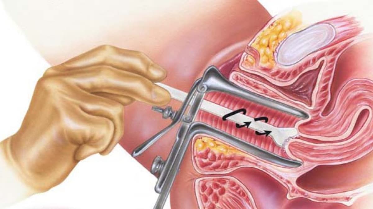 Phẫu thuật cắt tử cung hoàn toàn và những điều cần biết!