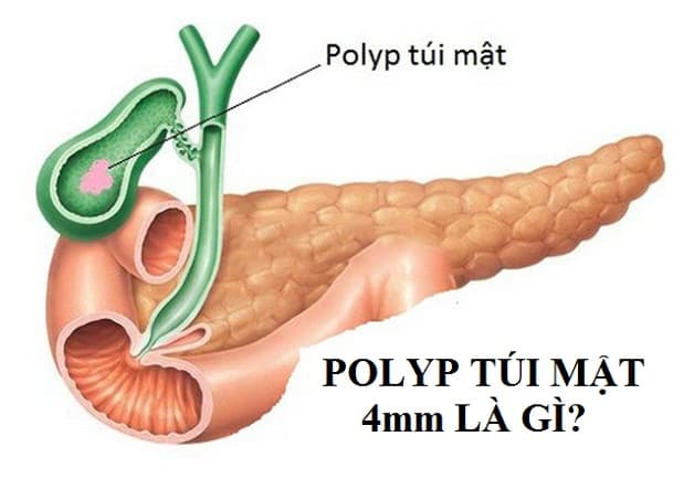 polyp túi mật 4mm là gì, có cần phẫu thuật không?