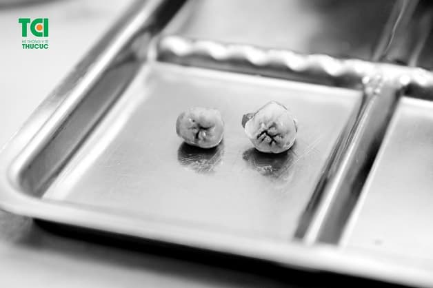 Răng khôn mọc thẳng nhưng bị sâu răng được nhổ bỏ