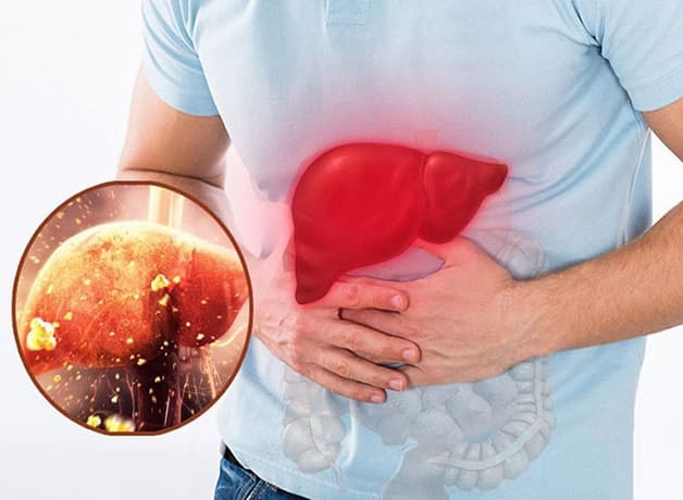 Men gan cao làm suy giảm chức năng gan