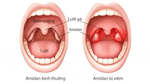 Viêm amidan xuất hiện khi cơ thể trẻ bị quá nhiều vi khuẩn hoặc virus ồ ạt xâm nhập vào cơ thể và amidan không đủ sức kháng cự.