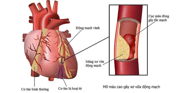 Triệu chứng bệnh mạch vành tim và cách điều trị
