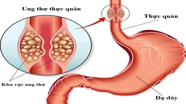 Triệu chứng bệnh ung thư thực quản không thể chủ quan