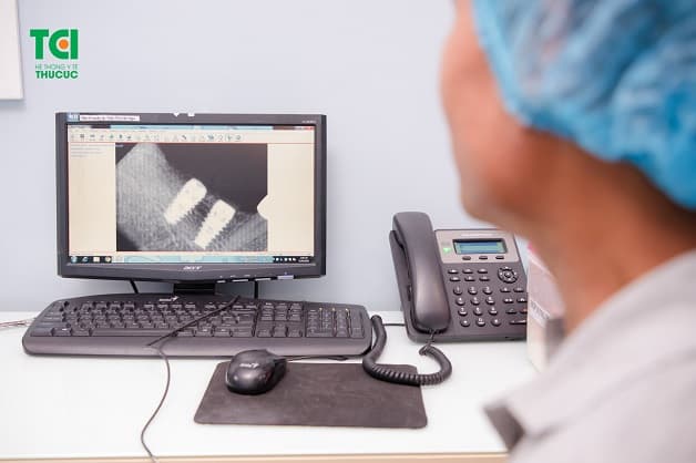 Kiểm tra quá trình tích hợp trụ Implant và xương hàm