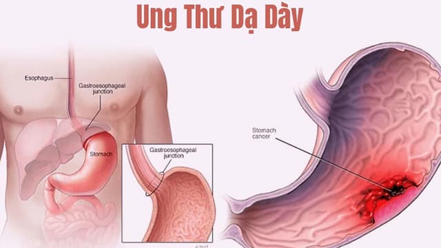 Ung thư dạ dày có biểu hiện gì? Xem ngay để phòng ngừa
