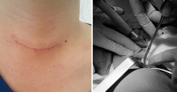 Lựa chọn mổ u tuyến giáp ở bệnh viện nào tốt nhất