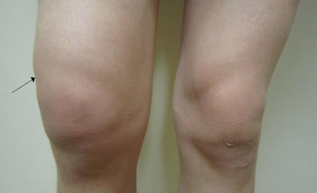 biểu hiện của tràn dịch khớp gối