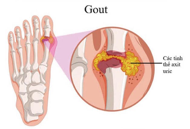 viêm khớp ngón chân do đâu