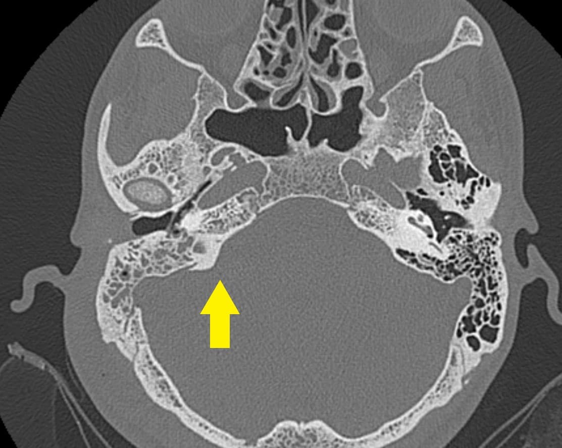Chẩn đoán viêm xương chũm