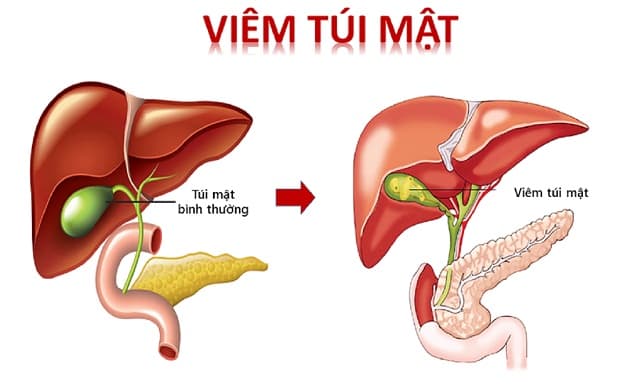 Nguyên nhân chủ yếu gây viêm túi mật ở trẻ em là do thói quen ăn uống không khoa học dễ dẫn đến ứ trệ dịch mật và tạo sỏi túi mật gây viêm