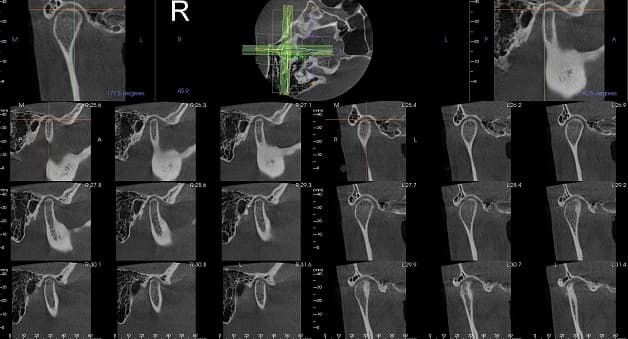 Chụp cắt lớp vi tính là gì?