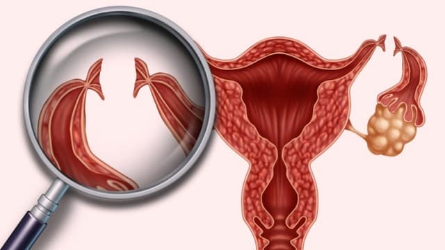 Chi phí nối ống dẫn trứng hết bao nhiêu tiền?