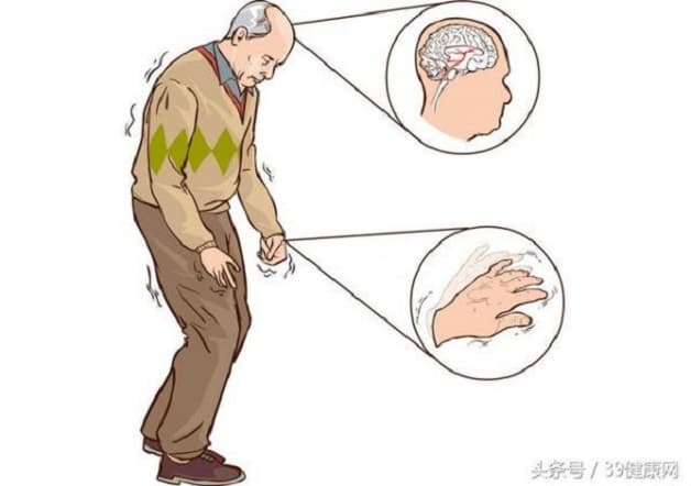 Dấu hiệu nhận biết bệnh Parkinson là gì?