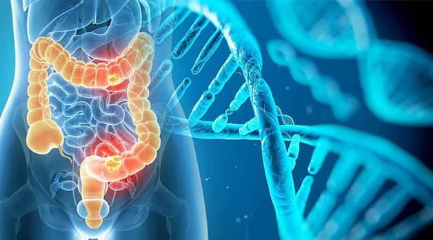 Ung thư trực tràng là bệnh xảy ra do tăng sinh mô ở đoạn ruột nối đại tràng và hậu môn.