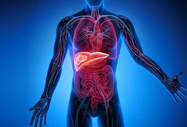 Bệnh viêm gan B là nguyên nhân gây xơ gan và ung thư gan