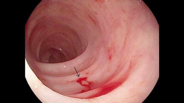 Bệnh xuất huyết tiêu hóa là cấp cứu y tế nghiêm trọng