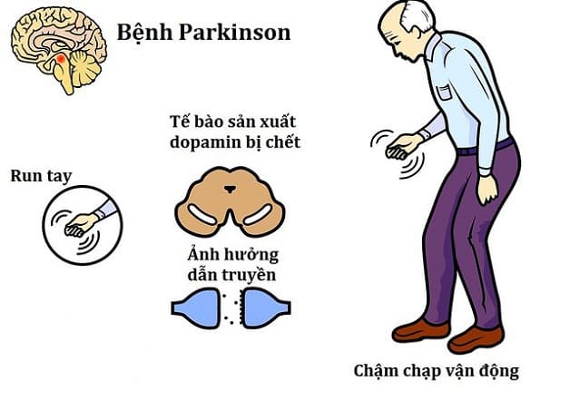 Bệnh lý parkinson nguyên nhân và biểu hiện