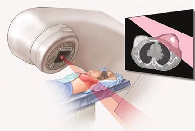 Điều trị ung thư vú tốn bao nhiêu tiền?