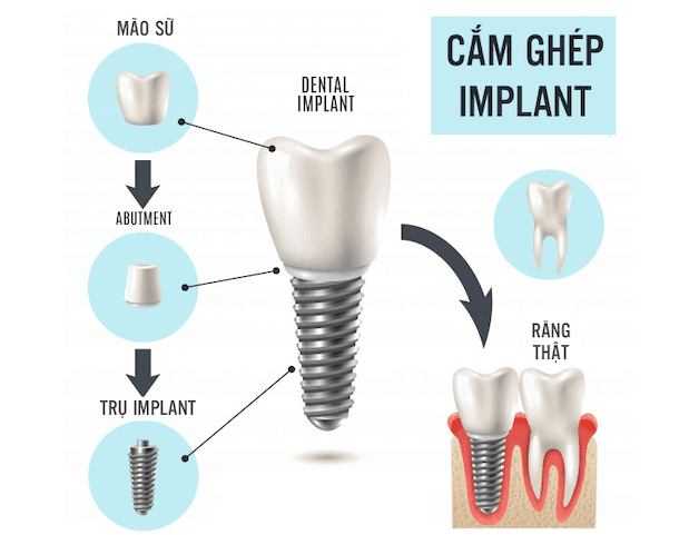 Trồng răng implant được đánh giá là giải pháp tối ưu cho hầu hết các trường hợp mất răng.