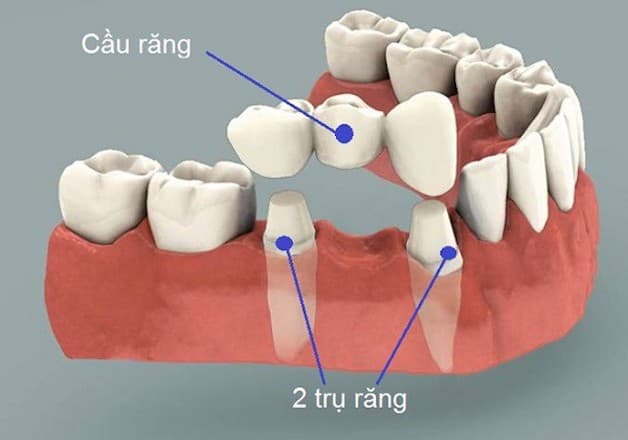 Cầu răng sứ là phương pháp có trước implant và là phương pháp phổ biến nhất từ trước đến nay.